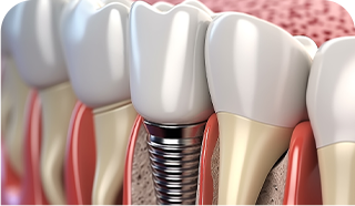 cross section illustration of gum showing tooth roots and metal base of implant